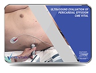 CME - Ultrasound Evaluation of Pericardial Effusion